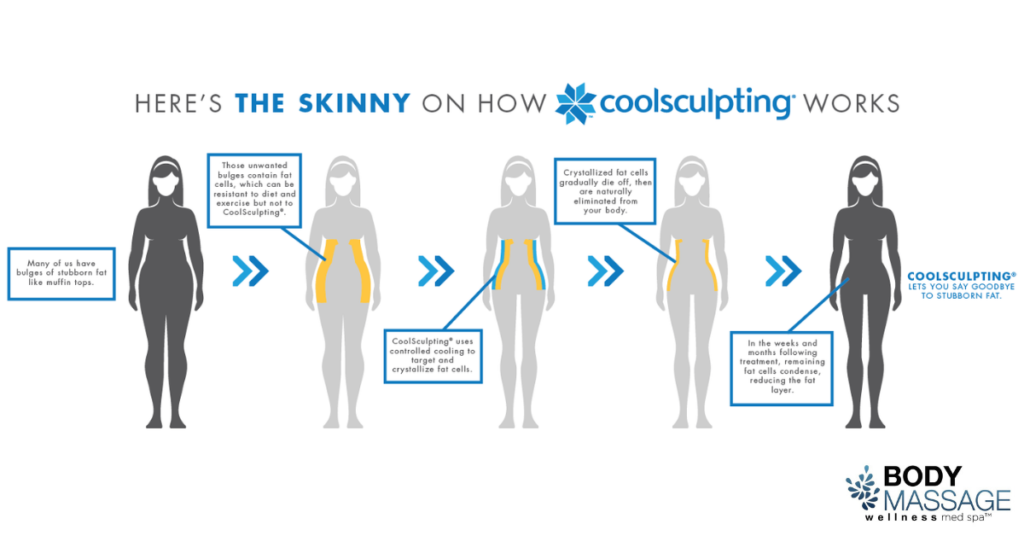 How does CoolSculpting work in Denver, CO?