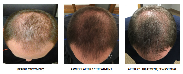 PRP Hair Restoration