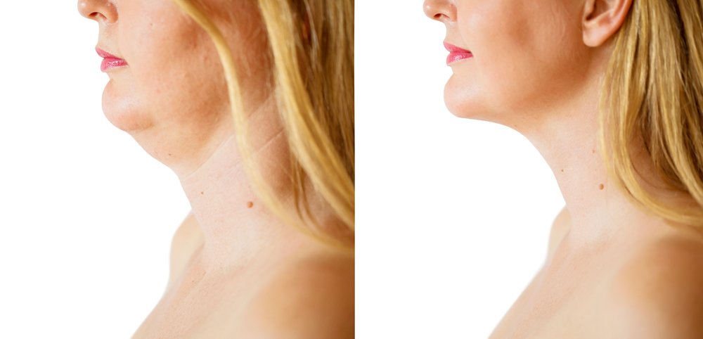 Coolsculpting before and after double chin