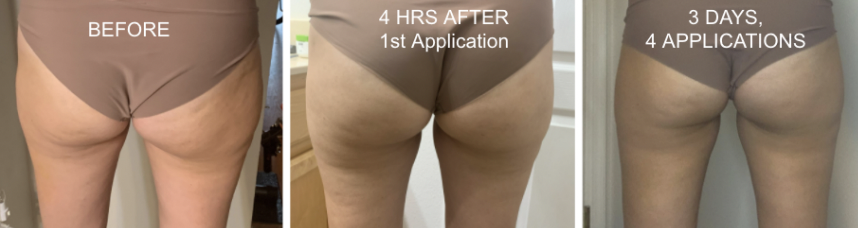 Weight Loss Before and After Thighs Pictures