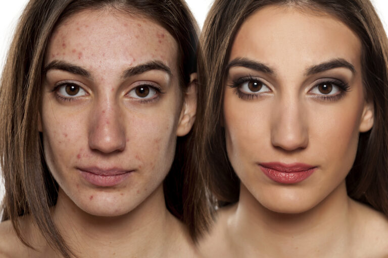 Acne treatment results: before & after